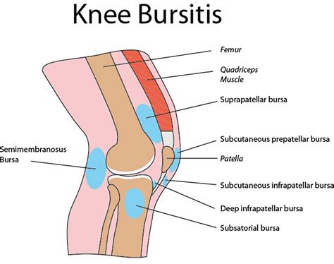 Infrapatellar bursitis causes, symptoms, diagnosis & treatment