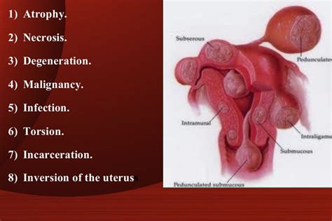 Fibroid uterus