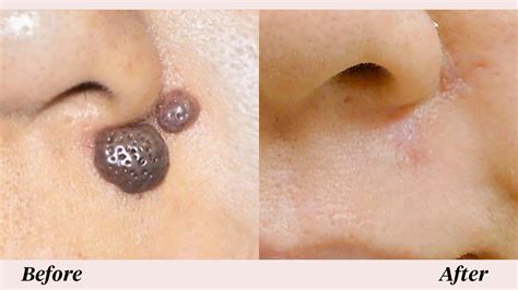 mole removal dermatologist or plastic surgeon - kyte-glinka