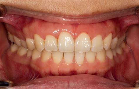 Periodontal / Gum Disease Treatment in Maidstone, Kent | TIE