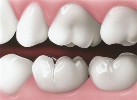 Your Best Options for Repairing a Cracked Tooth - Your Dental Health Resource