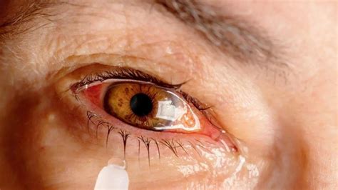 Pink eye: Causes and prevention tips