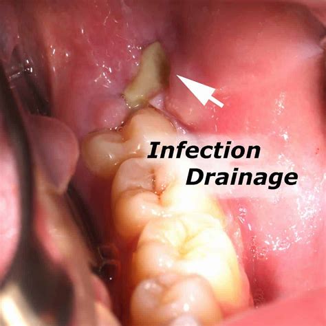 Infection Where Wisdom Tooth Used To Be