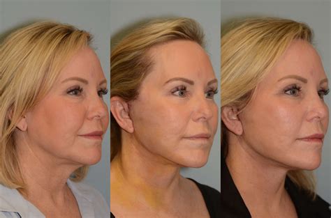 Facelift, Neck lift Houston