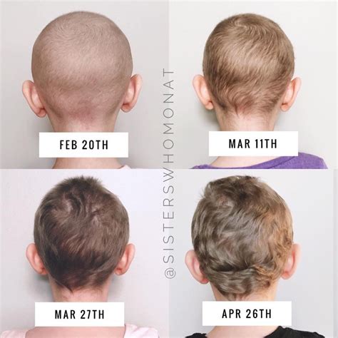 How long after chemo lose hair | hairstyles6g