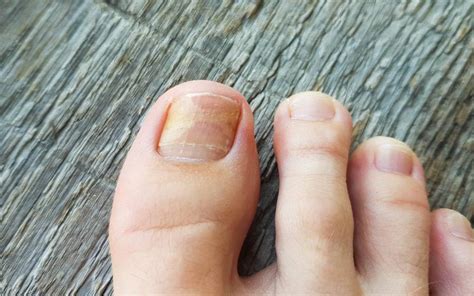 Hydrogen Peroxide Toenail Fungus Before And After - lvandcola