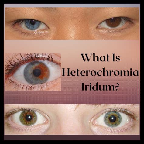 Heterochromia Iridum: People With Two Different Colored Eyes - Owlcation