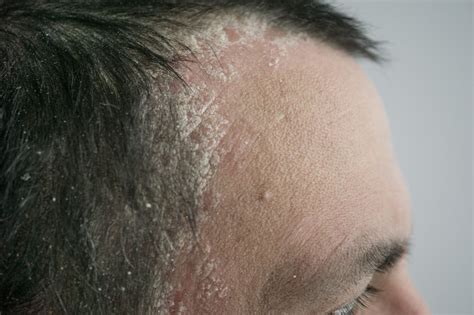 Scalp Psoriasis: What Dermatologists Wish You Knew | The Healthy