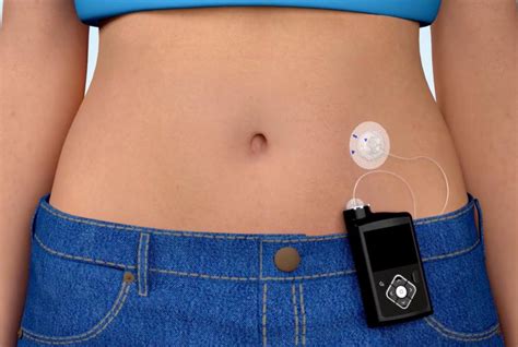 Insulin Pump Therapy | Medtronic Diabetes