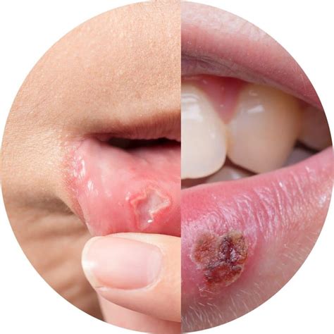 Canker Sore Vs Cold Sore Inside Lip