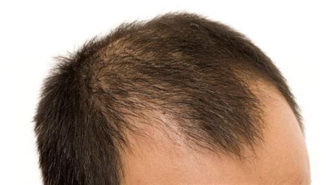 Male Pattern Baldness (Androgenic Alopecia): Stages, Treatment