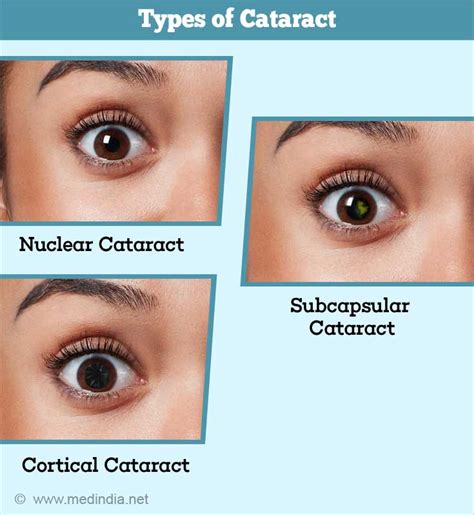 Cataract Symptoms