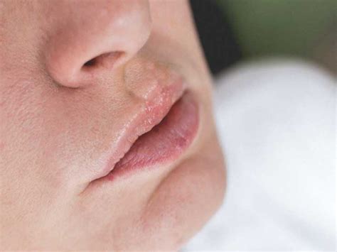 Upper Lip Swelling Food Allergy | Sitelip.org