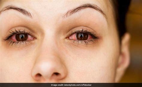 Conjunctivitis And Eye Infection Cases Surge After Rains: Know Symptoms, Prevention Tips ...