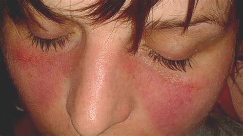 Lupus: What Is It, Symptoms, Treatment, Rash, and More