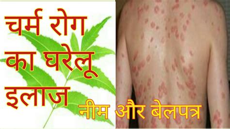 Home Remedies for Skin Disease #9027176277 - YouTube