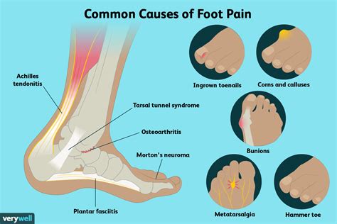 Foot Pain Diagram Side