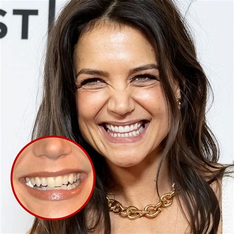 21 Celebrity Dental Implants And Veneers: Before And After