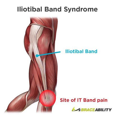 Iliotibial Band Syndrome | IT Band Stretchs, Exercises & Treatment