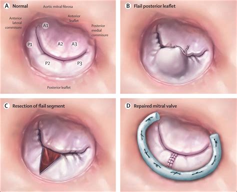 Cleft Mitral Valve Ideas Mitral Valve Mitral Valve Regurgitation | The ...