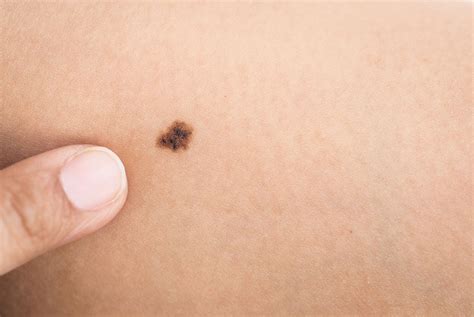 Pictures of cancerous moles: early stage, cancerous moles images, pictures of skin moles ...