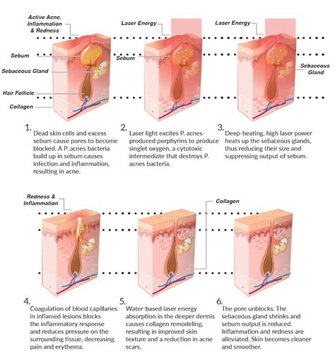 Acne-Mechanism-Diagram_Neo - Elyse S. Rafal M.D. | Center for ...