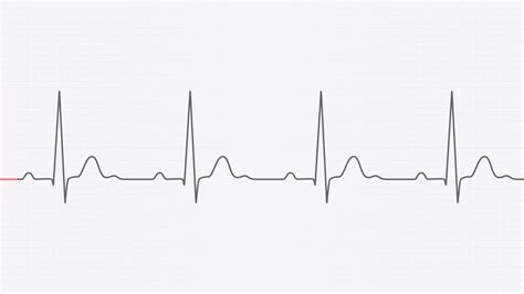 ecg | Impulse First Aid