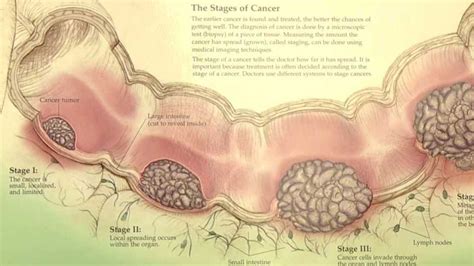 Colorectal Cancer Information