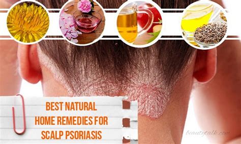 16 Best Natural Home Remedies For Scalp Psoriasis