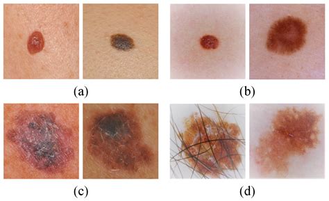 Melanoma Skin Cancer Stages