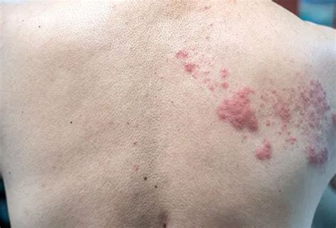 What Does a Shingles Rash Look Like at First? - Okkii.com