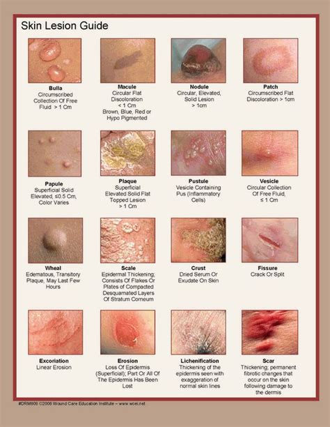 Share Everything: Gambaran Jenis Kelainan Pada Kulit (Skin Lesion Guide)