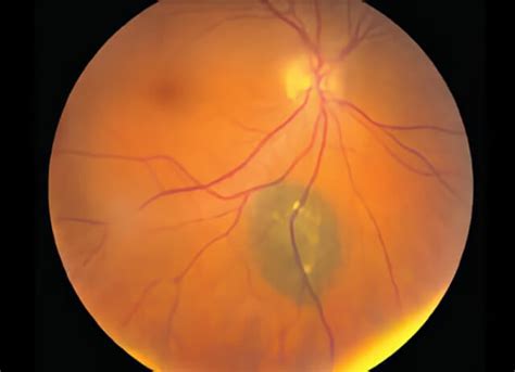 Choroidal Nevus Treatment | Retinal Consultants Medical Group