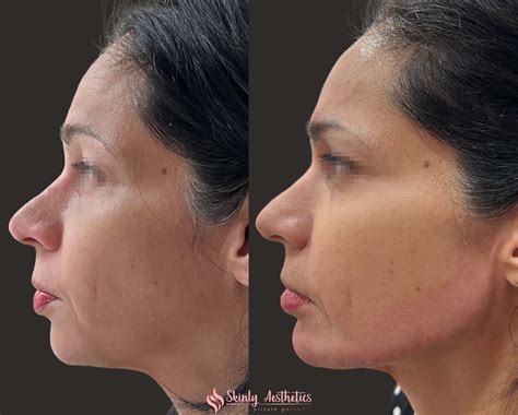 Chin Filler Injections - Benefits, Cost, Results & Procedure Steps