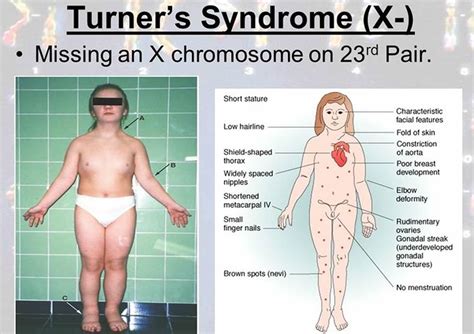 Turner Syndrome - Causes, Symptoms, Life Expectancy, Treatment