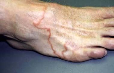 Hookworm Skin Infection