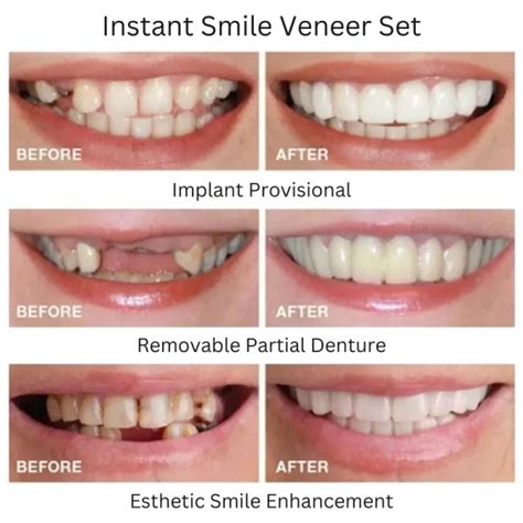 Instant Smile Snap On Veneers (Upper & Lower) Teeth Veneers