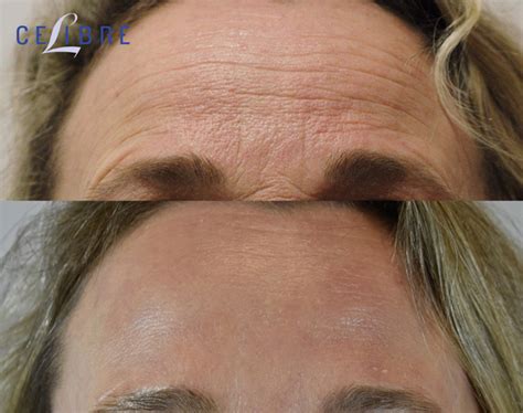 Botox Before and After Pictures: Real Results from Real Patients