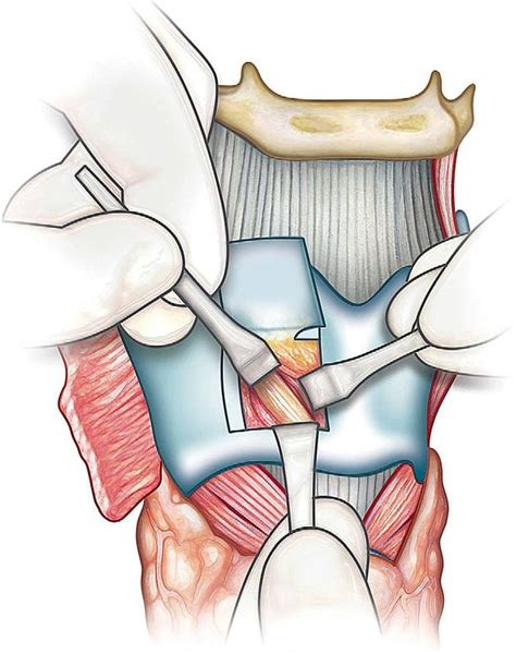 Laryngeal surgery in Iran with Dr. Saeedi | ENT Surgeon