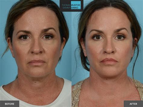 What To Do Before And After A Facelift Surgery