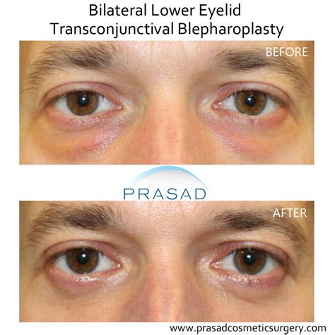 Can Eye Bag Surgery Go Wrong? | Dr. Prasad Blog