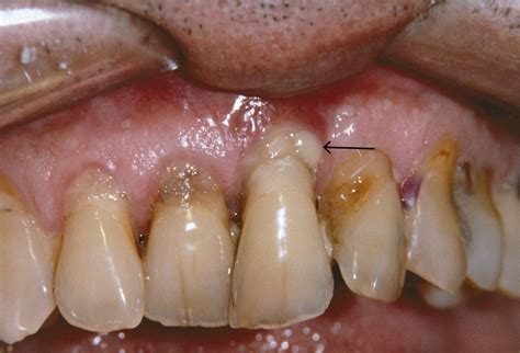 periodontal disease - Pierce Family Dentistry