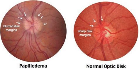 Papilledema: - Ophthalmology-Notes And Synopses