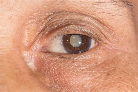 Pros and Cons of Cataract Treatments