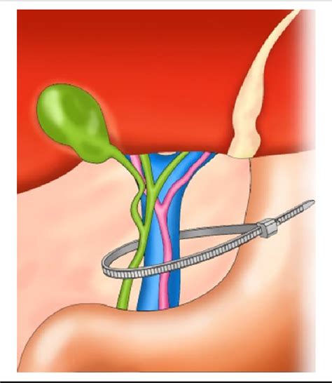 Pringle’s Maneuver With a Releasable Insulok Band | Semantic Scholar