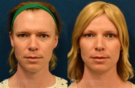 Facial Feminization Surgery (FFS): Dr. Mark Schoemann