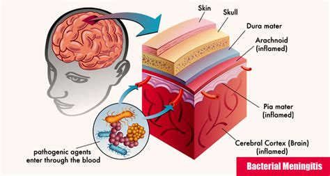 List of Brain Diseases with Brief Description