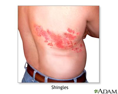 Shingles Information | Mount Sinai - New York