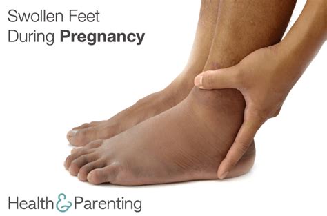 How To Reduce Feet Swelling During Pregnancy - Stuffjourney ...