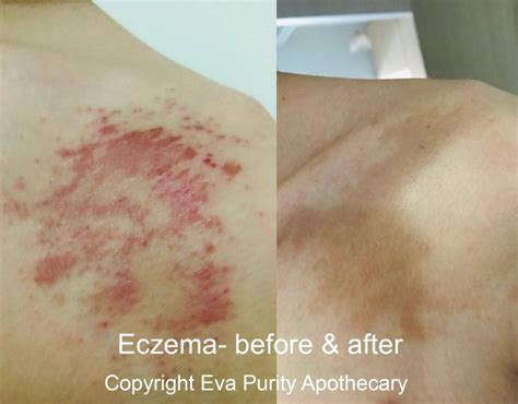 Eczema Before And After